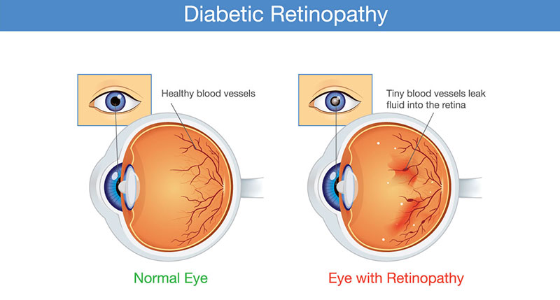 15 Facts About Diabetic Retinopathy
